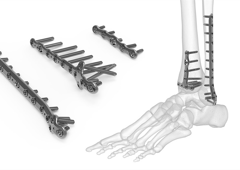 跖骨骨折恢复后影响跑步吗,内踝骨折手术恢复后还能跑步吗