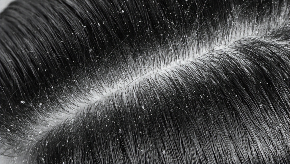 头皮屑特别多你该怎么治,头皮屑多有什么解决方法吗