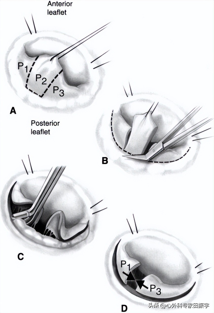 二尖瓣成形术要多少钱,二尖瓣成形术后抗凝多久