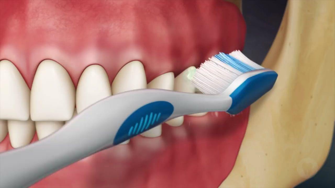 牙缝中的牙结石怎么去除,牙缝间的牙结石怎么清除