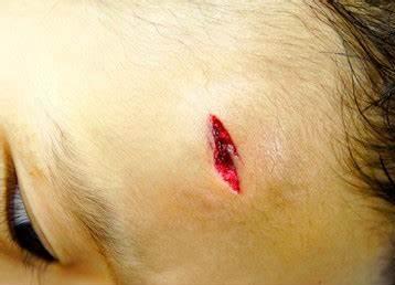 孩子碰伤了怎么祛疤痕,儿童凹陷性疤痕彻底修复方法