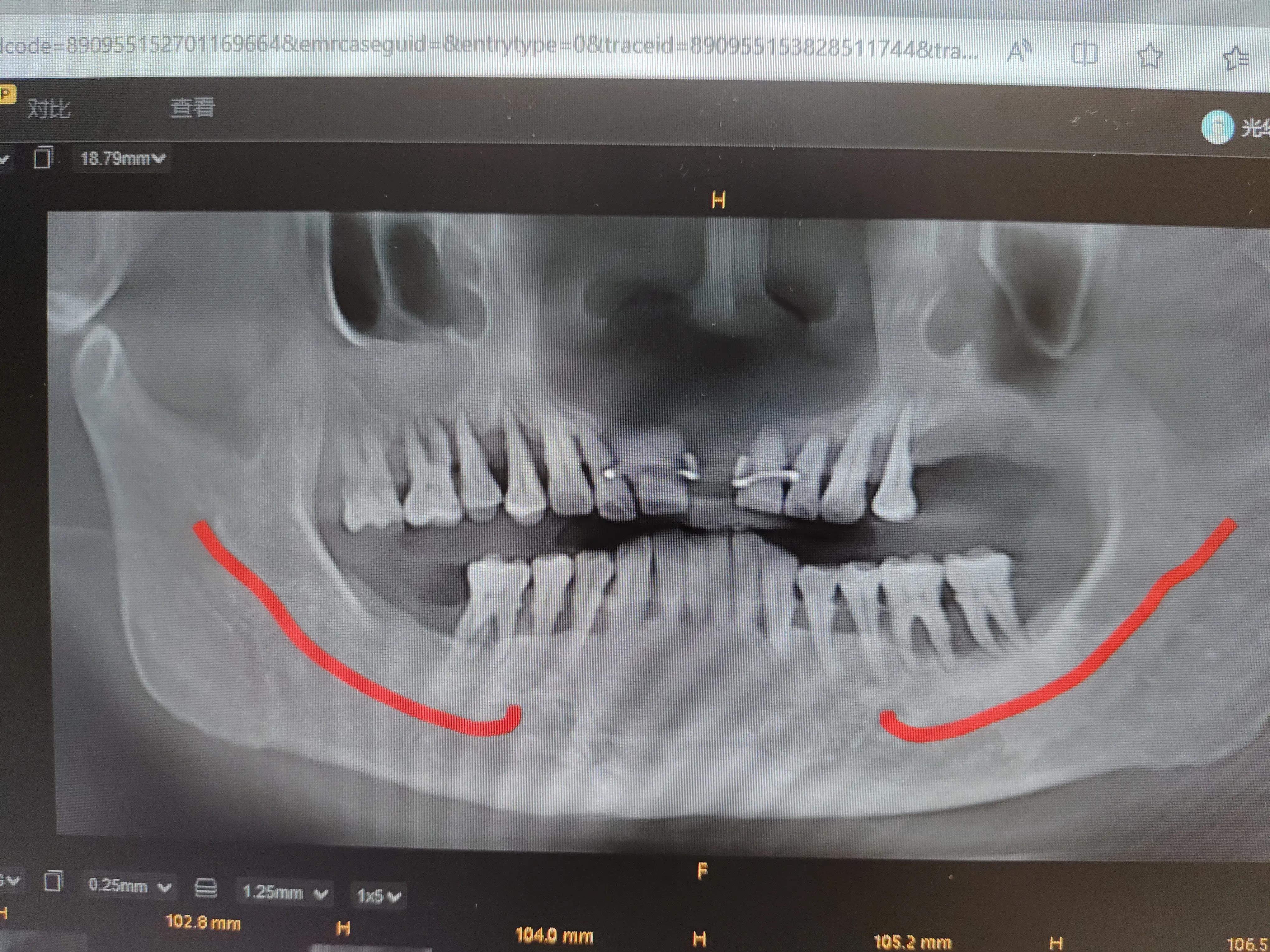 牙龈萎缩好几年了终于治好了,牙龈萎缩治好了案例
