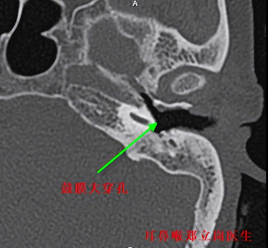 耳骨链断裂手术怎么做,听骨链重建和耳膜修复住院多久