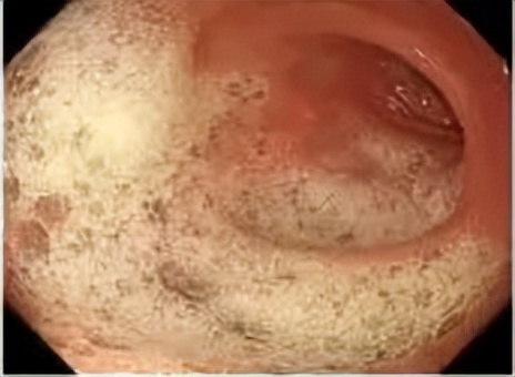 肠道准备不满意影响视野,肠道准备不充分肠镜会漏诊吗