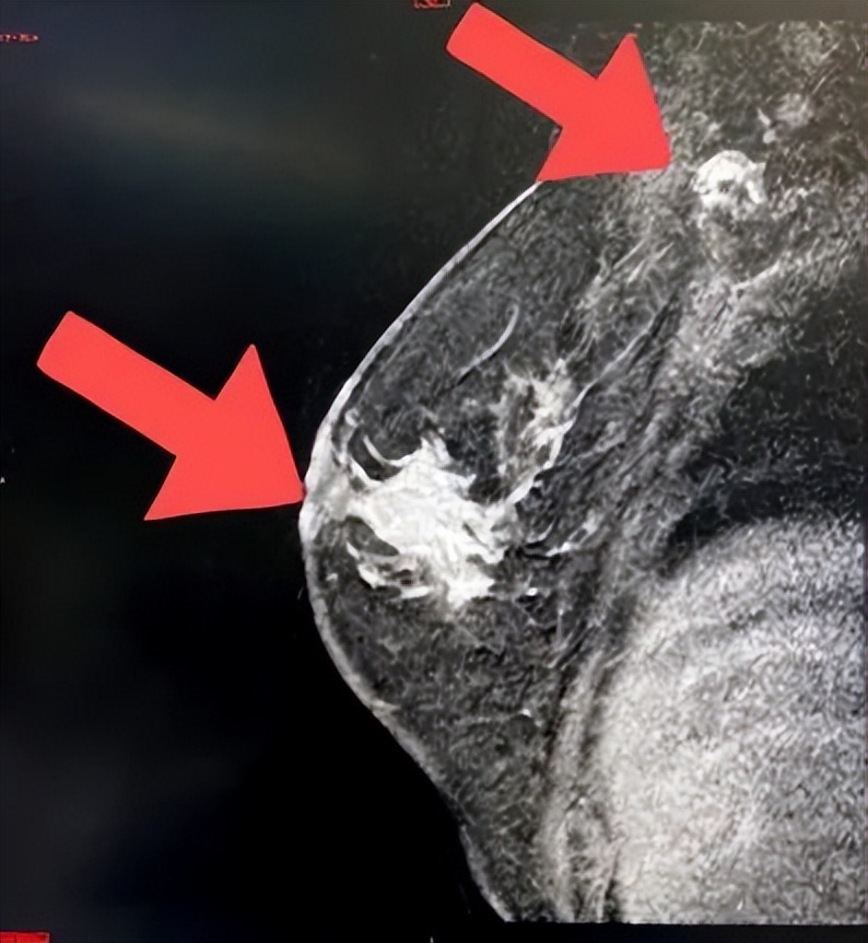 汉曲优曲妥珠单抗治疗效果,her2阳性乳腺癌新辅助治疗的启示