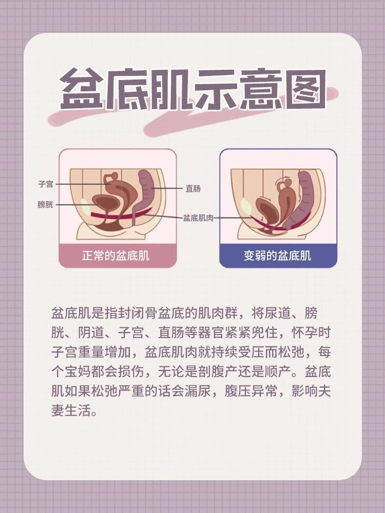 剖宫产后多久可以做盆底肌修复,产后盆底肌修复全攻略