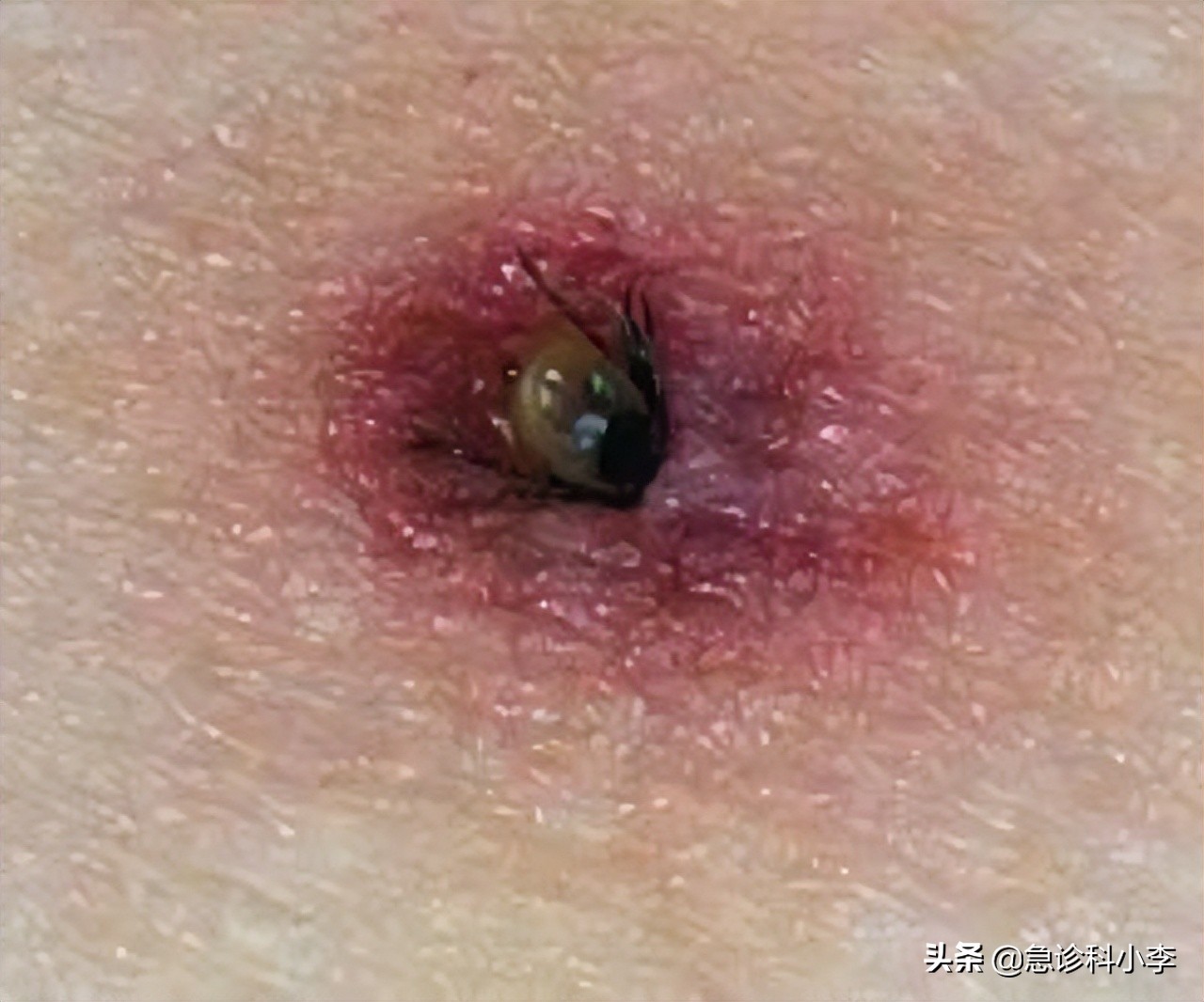 蜱虫咬人死亡率多少,蜱虫咬后死亡率新闻