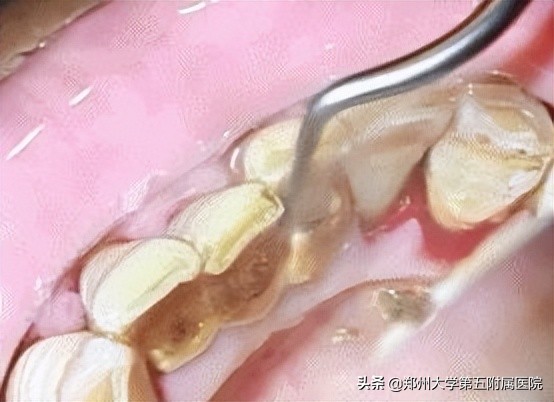 请问医生牙龈出血是怎么了,医学科普牙龈总是出血该怎么办呢