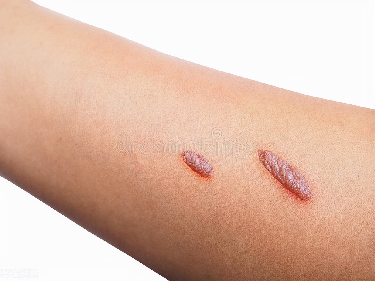 吃清热解毒的中药痔疮出血,痔疮出血中药