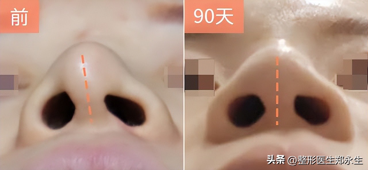 鼻子歪了怎么矫正,鼻子歪了矫正后呼吸会好吗