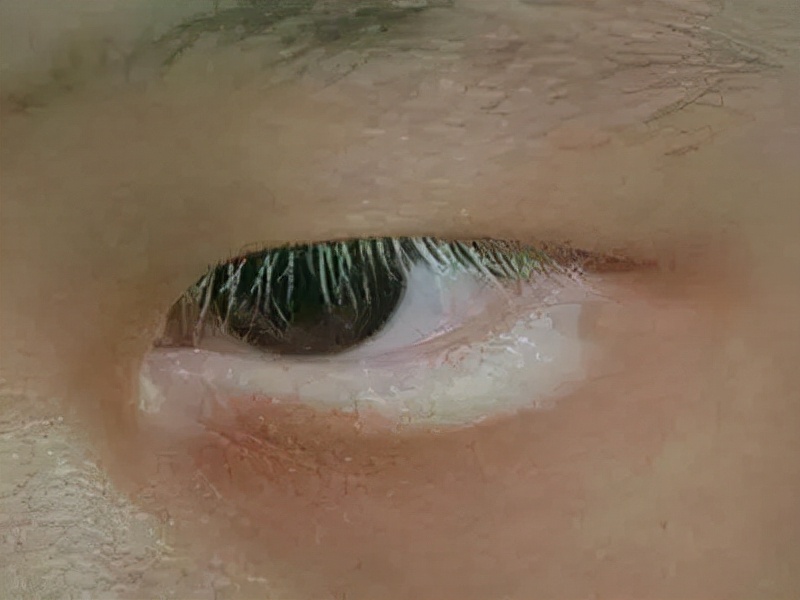 白癜风拖延治疗最终会变成什么样子？这下不敢再拖了