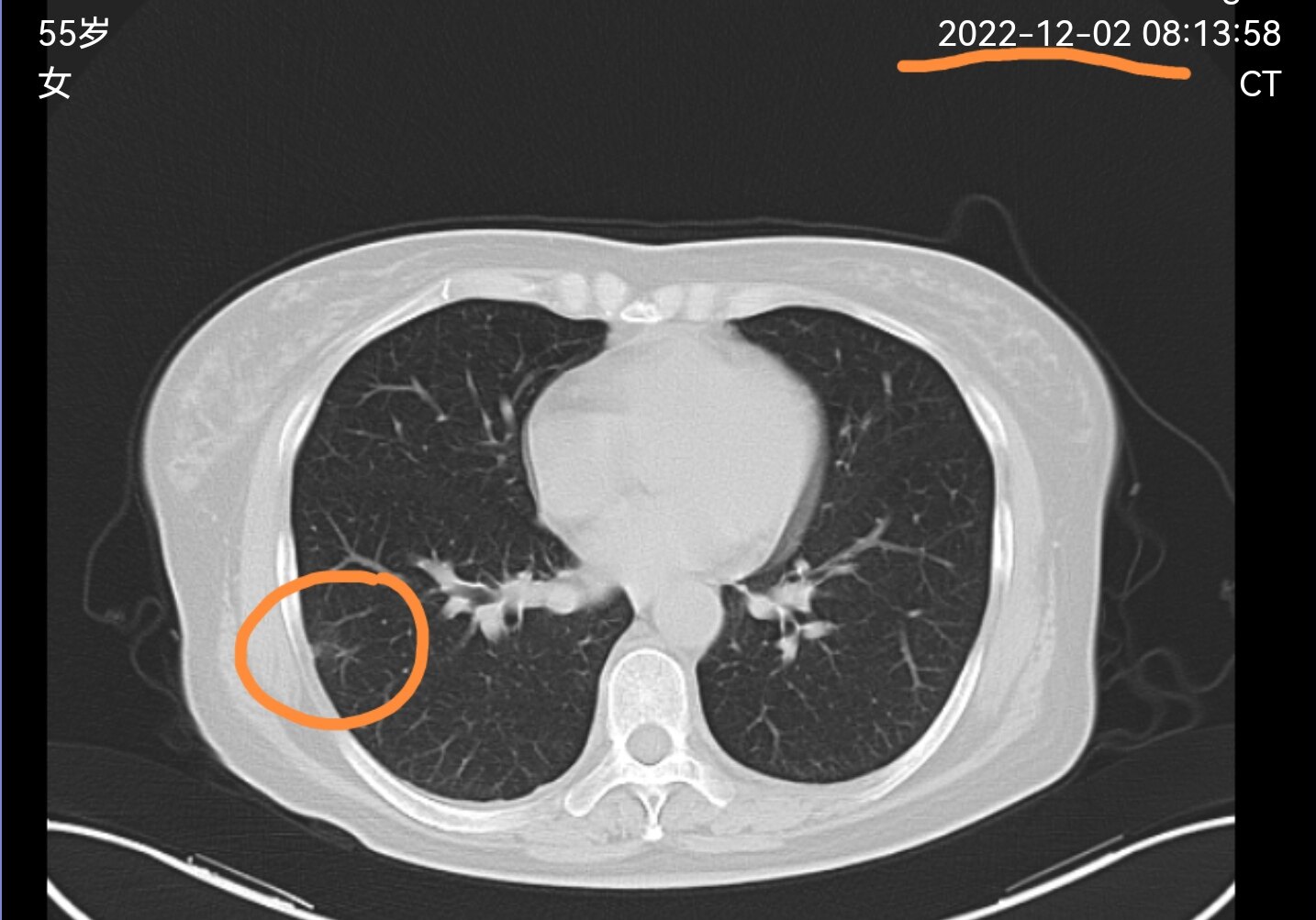 刘懿博士说肺癌全集,刘懿博士说肺癌毛玻璃结节