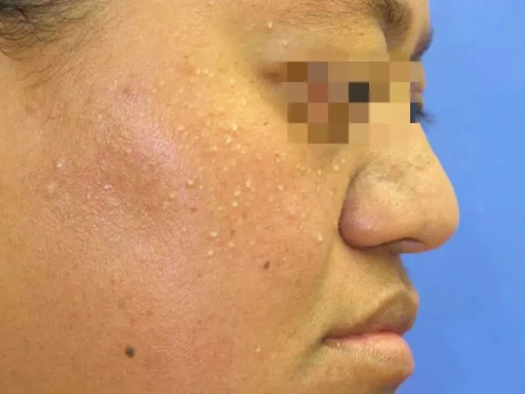 眼睛周围的脂肪粒怎么去除,怎么去除脂肪粒眼睛周围