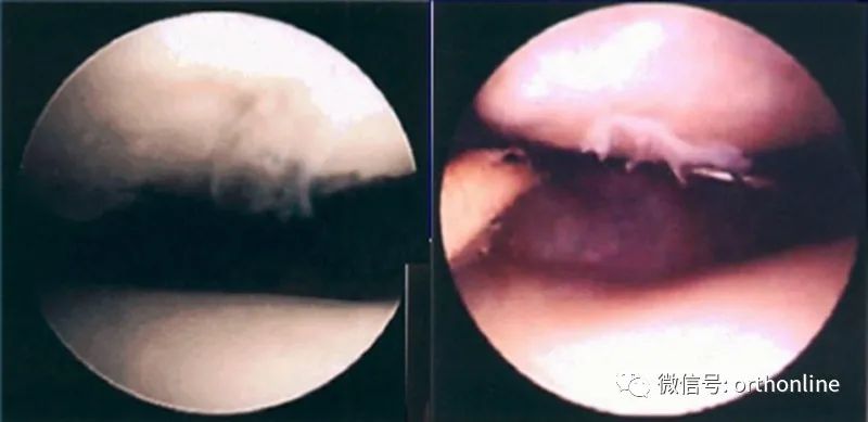 髌骨软化症的最佳疗法是什么,髌骨软化症治疗方法以及康复训练
