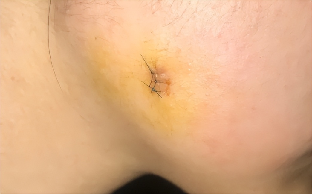 疤痕膏哪种效果最好,效果好的疤痕膏有哪些