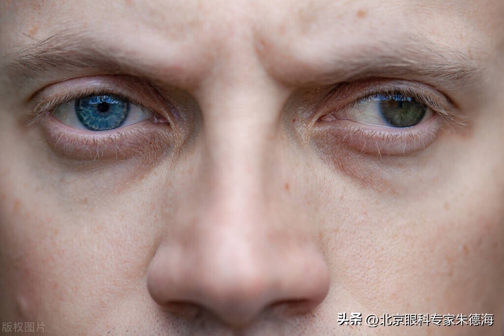 间歇性眼外斜怎么矫正,间歇性单眼外斜