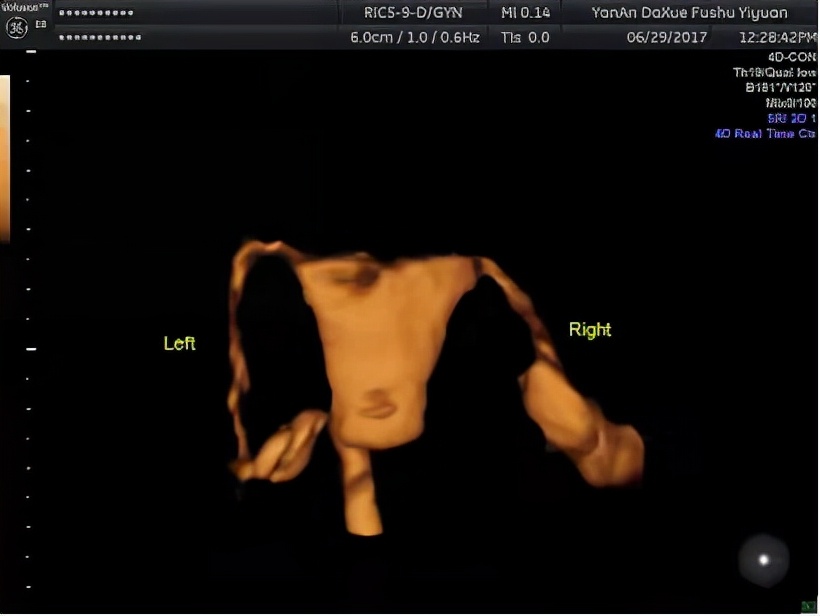 延大附院无痛输卵管四维超声造影为患者带来福音