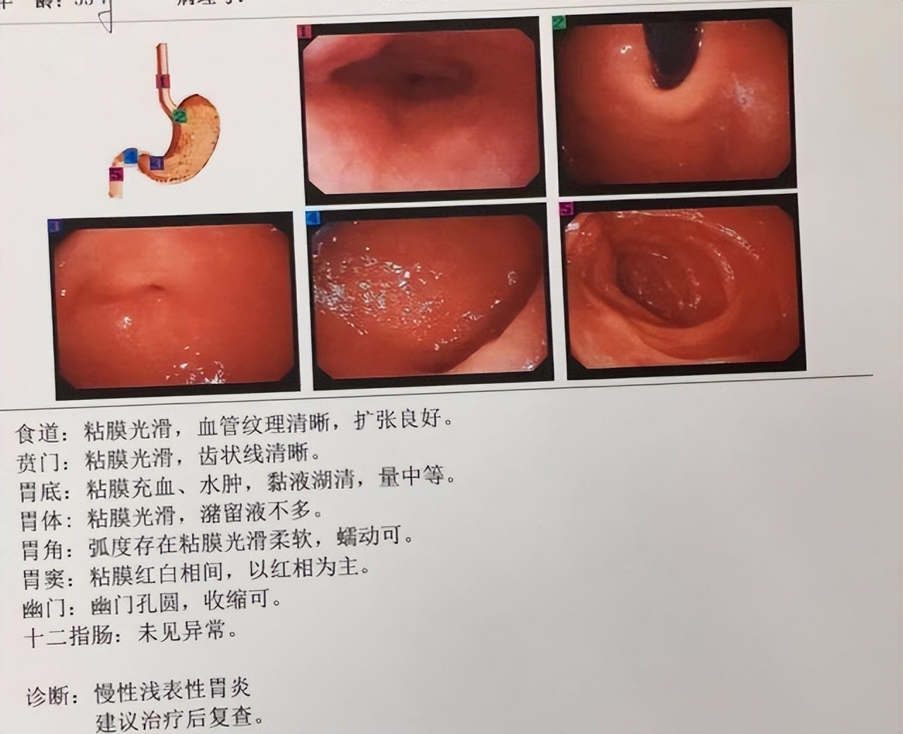 中医治疗慢性胃炎胃疼效果,中药治疗慢性胃炎胃胀胃痛