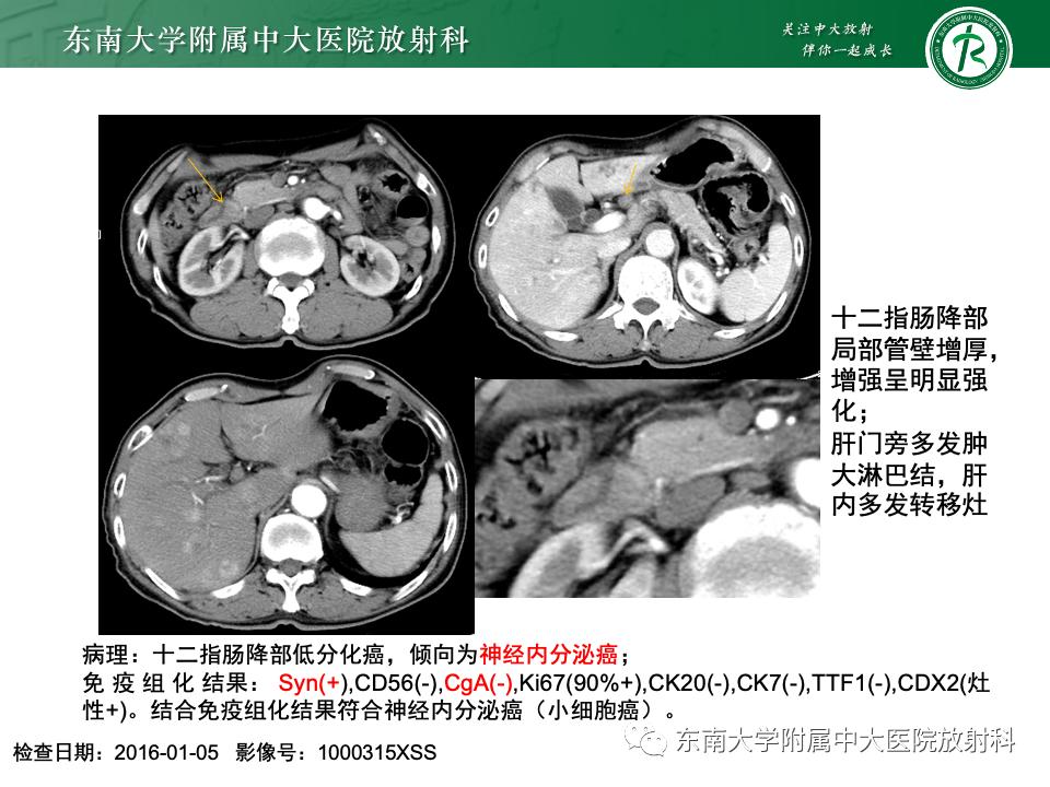 小肠间质瘤最新治疗中药方,小肠间质瘤基因检测