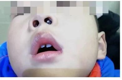 怎么治疗鼻出血,鼻出血介入治疗