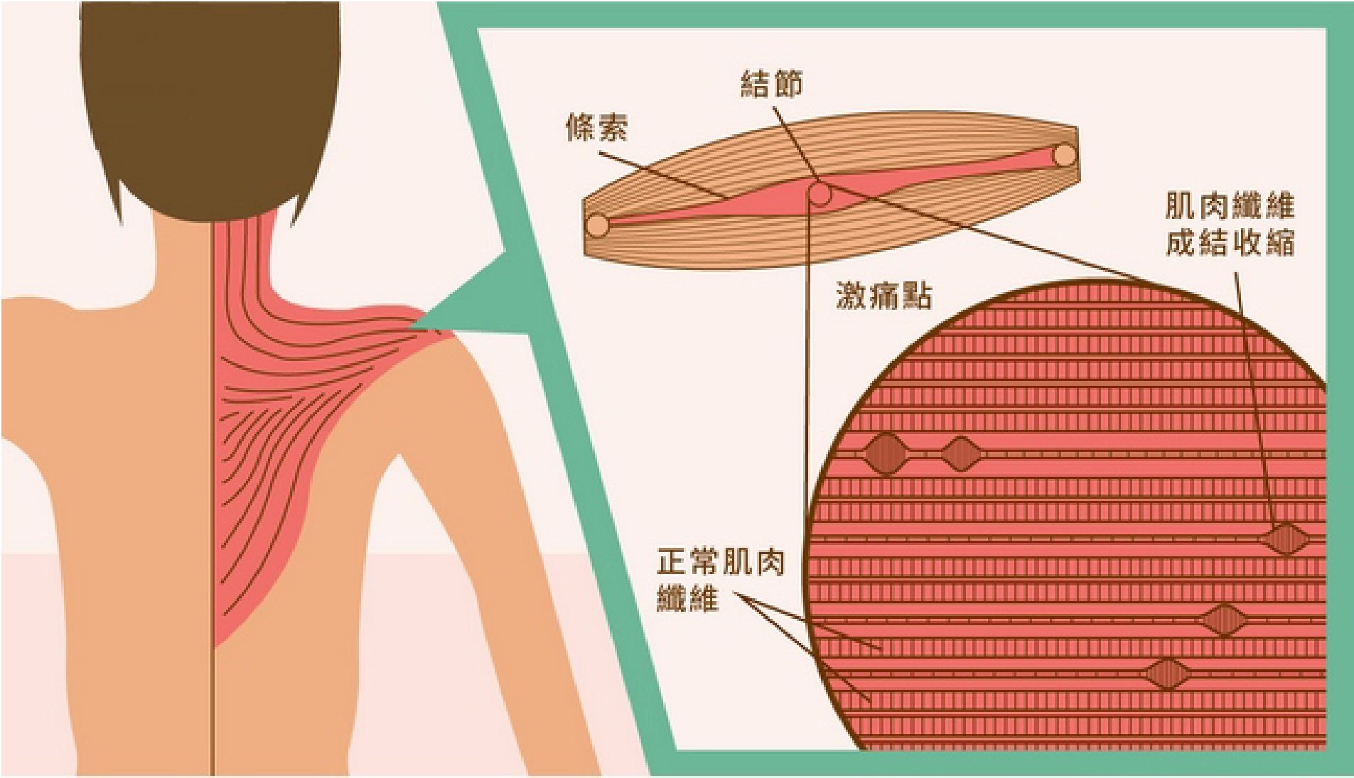 心脏病后背痛和肺癌后背痛的区别,58岁后背疼痛怎么回事