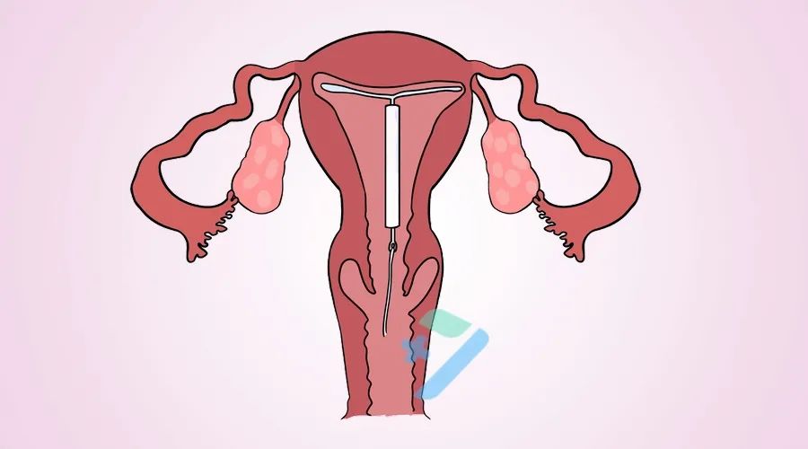 来大姨妈痛经可以打hpv疫苗吗,平时痛经可以接种hpv吗