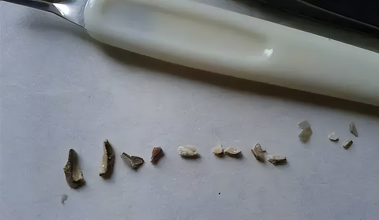 牙结石的根除方法,牙结石治疗全过程