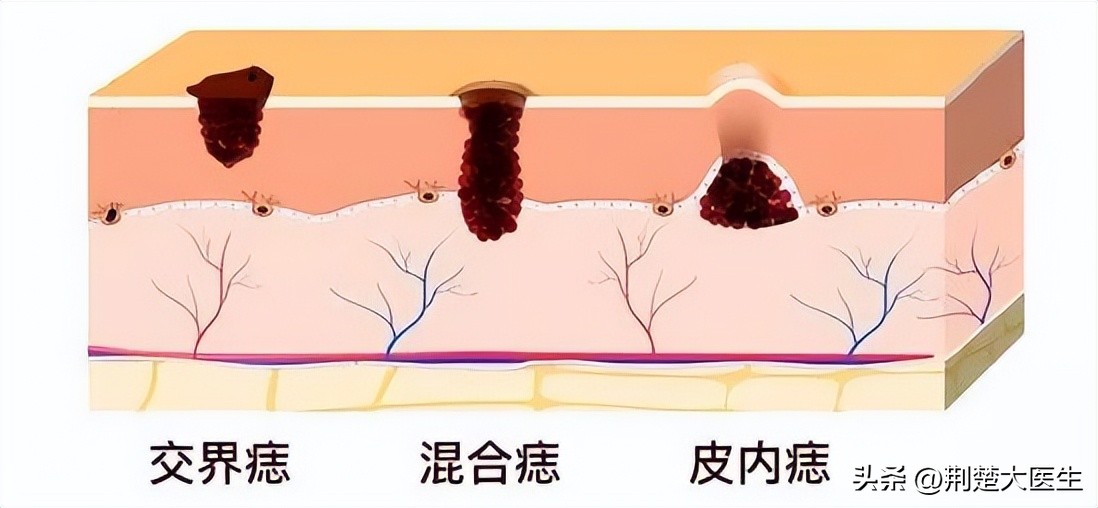 身上的痣有3种异常可能会癌变,如何判断身上的痣发生病变