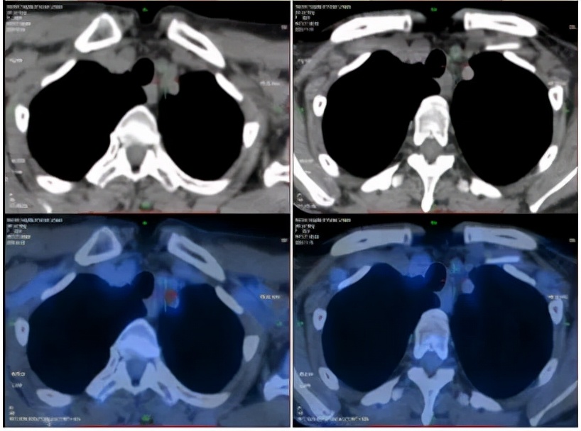 病例实录|免疫联合方案治疗胰腺癌多发转移的病例分享