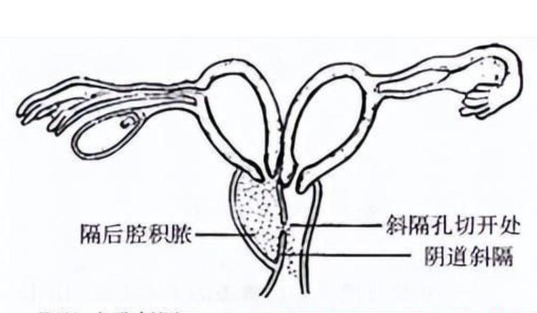 女子检查出两个子宫,女子查出双子宫
