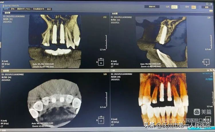 种植牙可修复多种牙齿缺失类型,学科建设口腔科