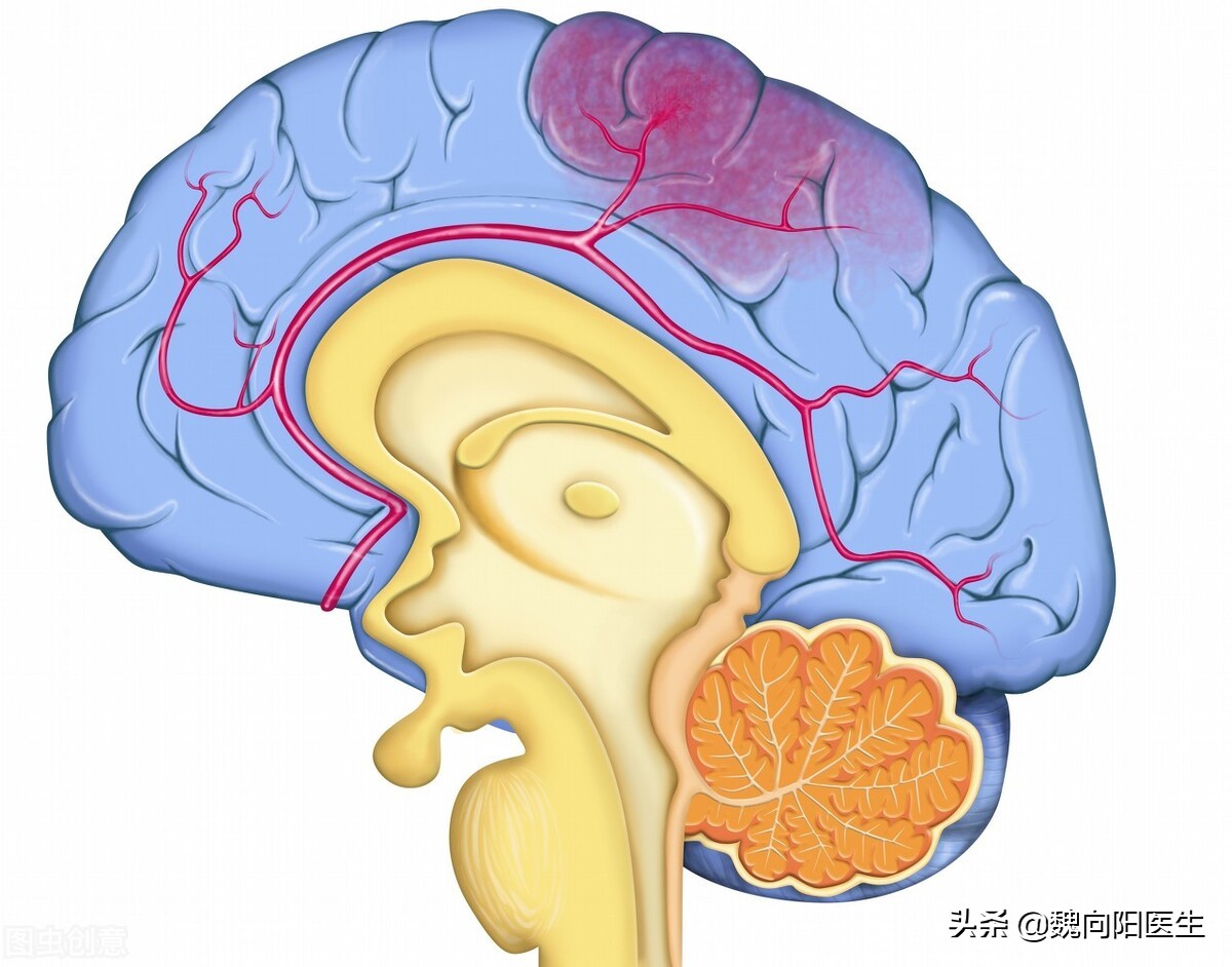 脑动脉狭窄需要血管搭桥吗,脑动脉狭窄不吃药行吗