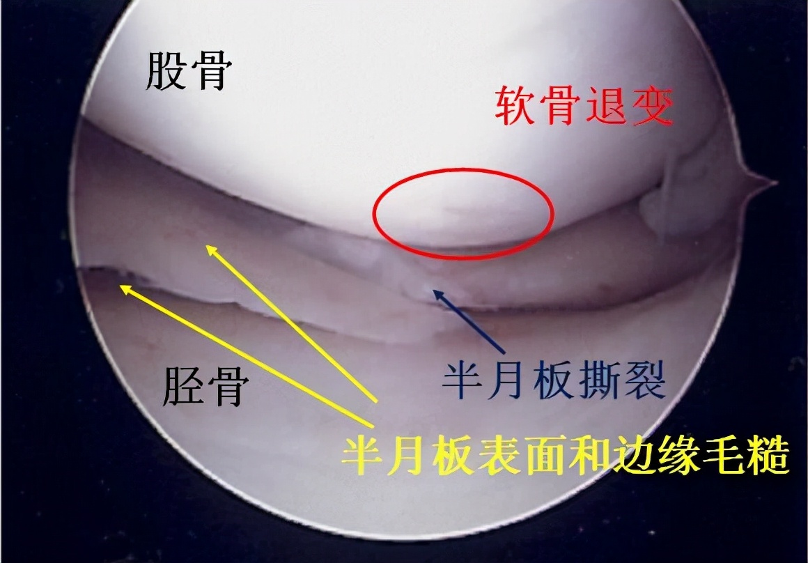 磁共振显示半月板损伤2到3级,磁共振半月板损伤一定要做手术吗