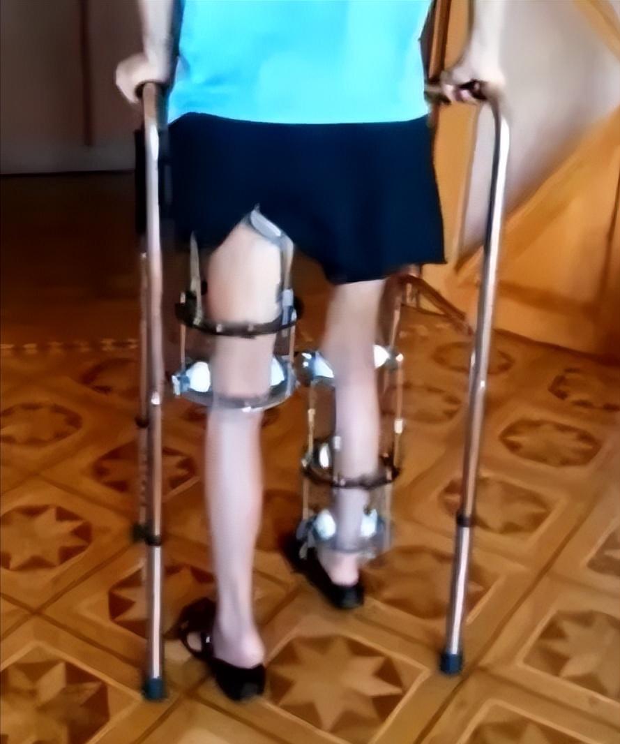 高中生花6.5万断骨增高,1米58男子花1500万增高