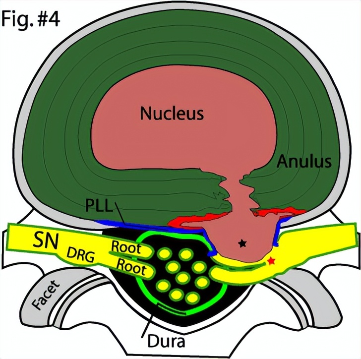腰椎间盘突出怎样让它缩小,腰椎间盘突出最快缓解方法学生