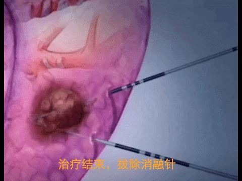 肺癌结节热消融术,肺肿瘤冷冻消融术能根治肺癌吗