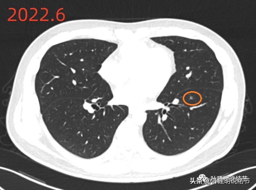肺炎好了磨玻璃结节还存在,球形肺炎治愈后肺部留有结节