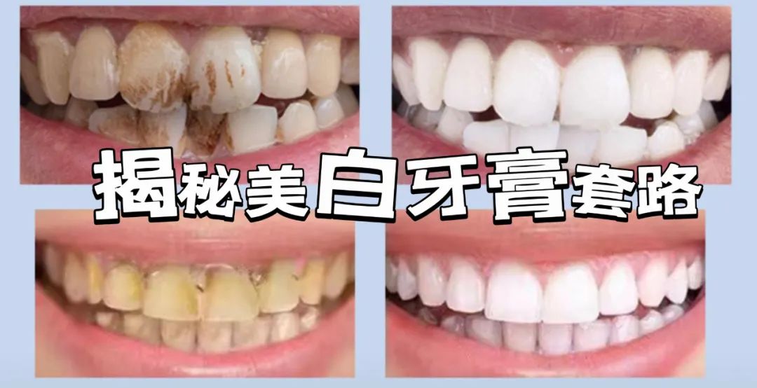 美白牙膏真的好用吗,美白牙膏效果是真的吗