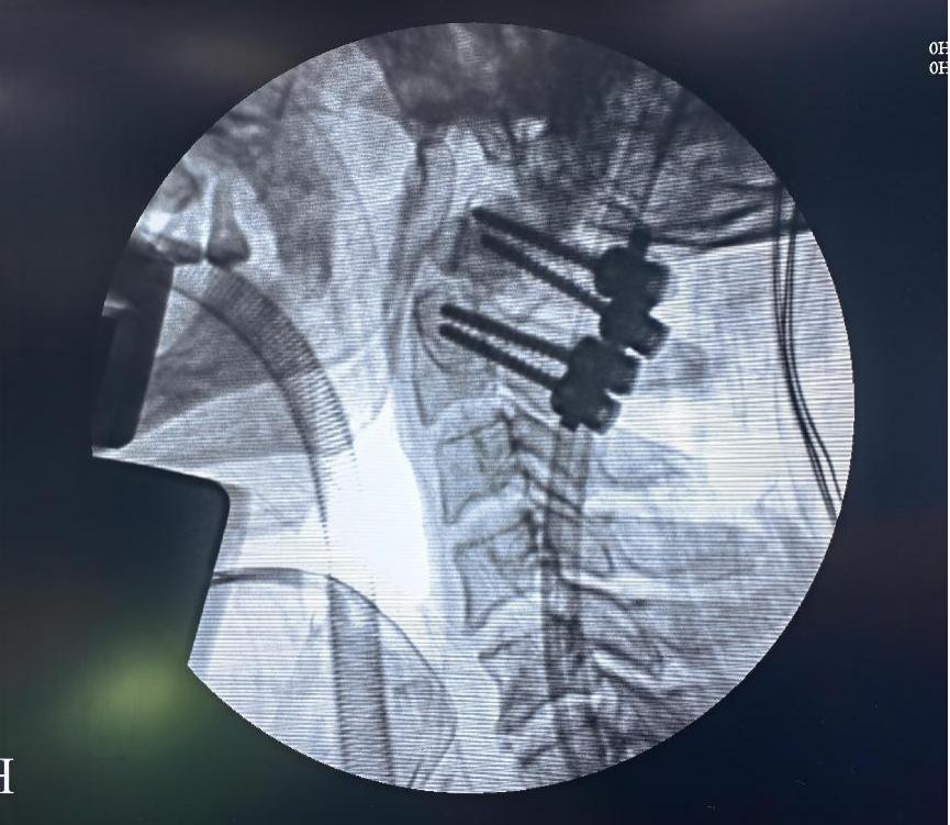 挑战骨折康复,颈椎如果摔断了会有什么后果