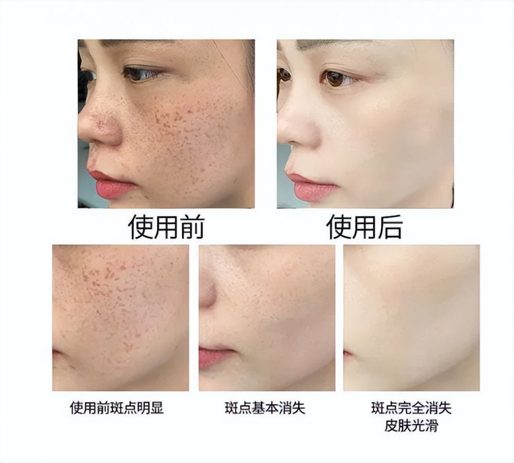 淡斑祛斑效果排名第一护肤品套装,大牌淡斑祛斑效果排名第一护肤品
