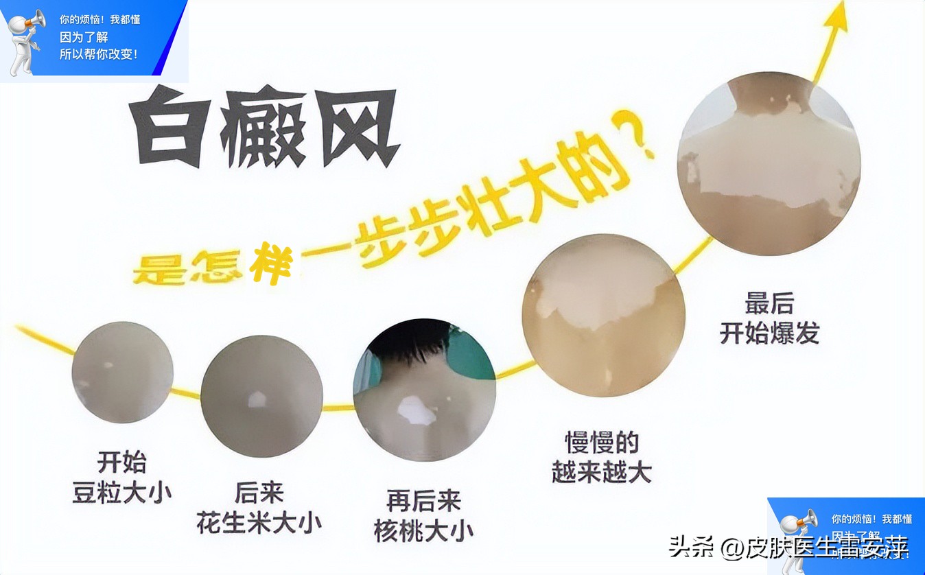 晕痣型白癜风怎么治疗,晕痣型白癜风治疗方法