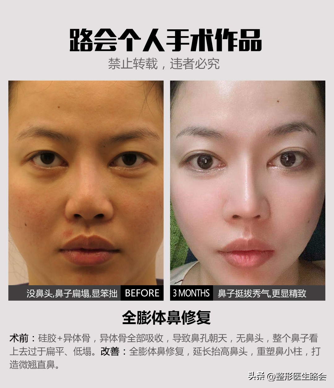 千万别做硅胶隆鼻,千万不要做玻尿酸隆鼻