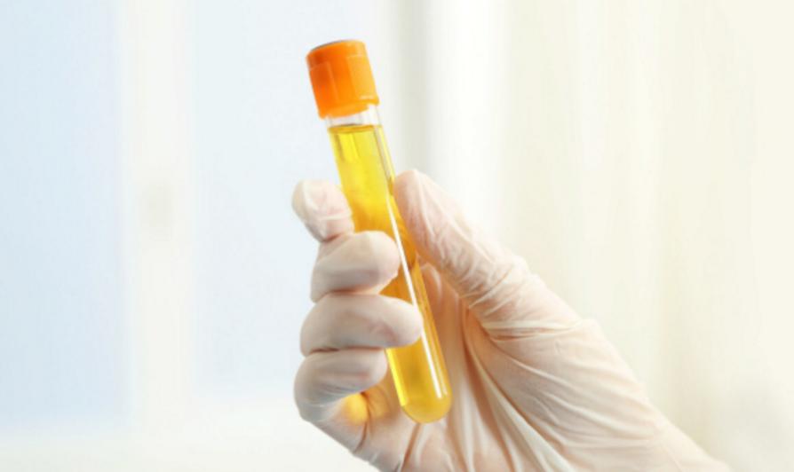 小便泡沫多和肾有什么关系,尿尿泡沫多是肾阴虚还是肾阳虚