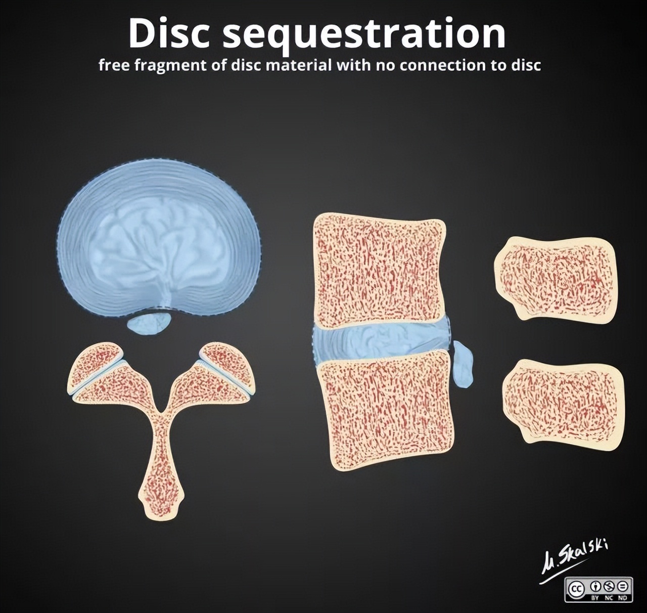 椎间盘突出膨出脱出如何治疗最好,椎间盘突出图怎么看