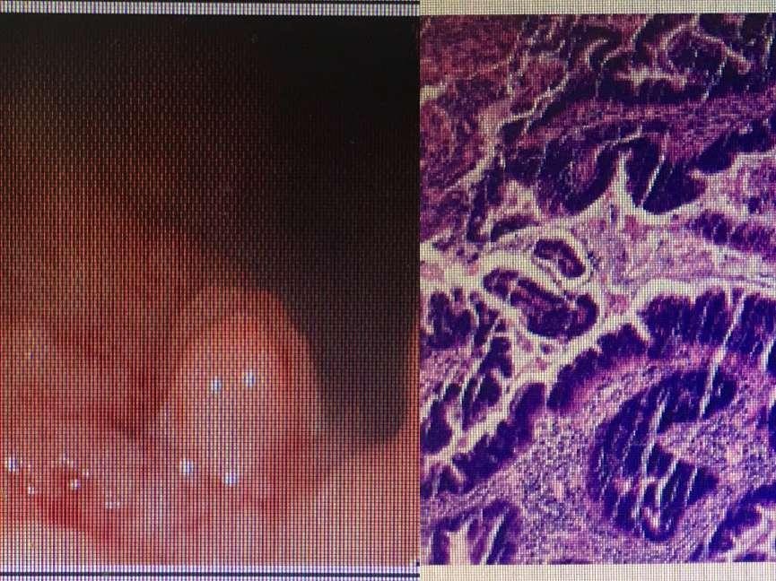 痔疮是肉赘还是疙瘩,肛门长了个肉赘无症状