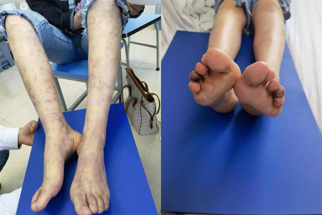 腿上起了湿疹又莫名的发青,女30岁腿脚老是肿怎么回事
