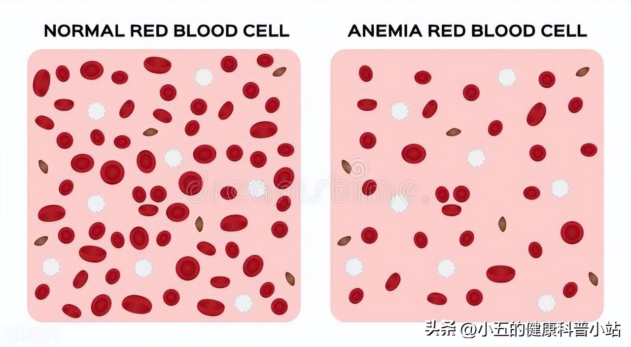 益气养血治疗贫血吗,生血宁片可以治贫血吗