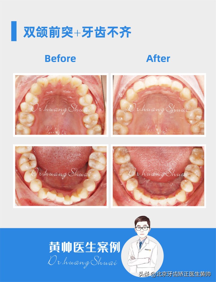 嘴凸的人怎么笑起来好看,嘴型比较凸的人怎么改善
