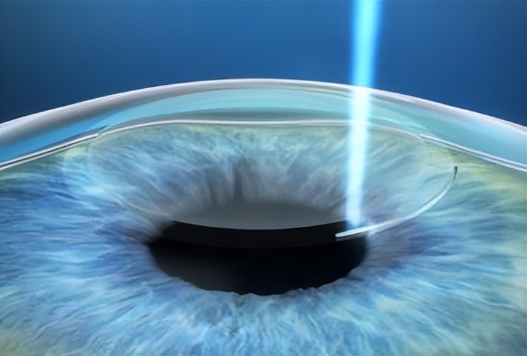 近视眼做飞秒激光有什么后遗症,用激光治近视眼