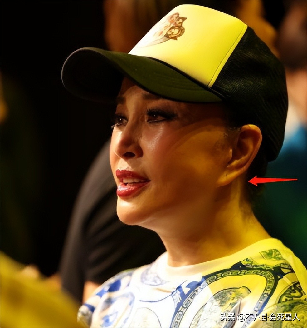 拉皮的女明星后遗症,拉皮失败的明星